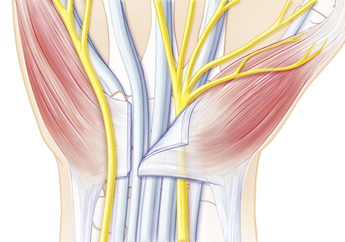 Karpaltunnelsyndrom (Carpal-Tunnel-Syndrom) | Schulthess Klinik