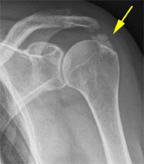 Impingement Syndrom | Schulthess Klinik