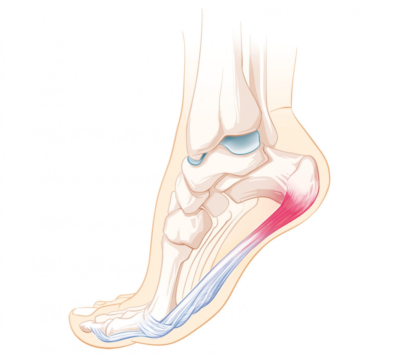 Fersenschmerz | Schulthess Klinik