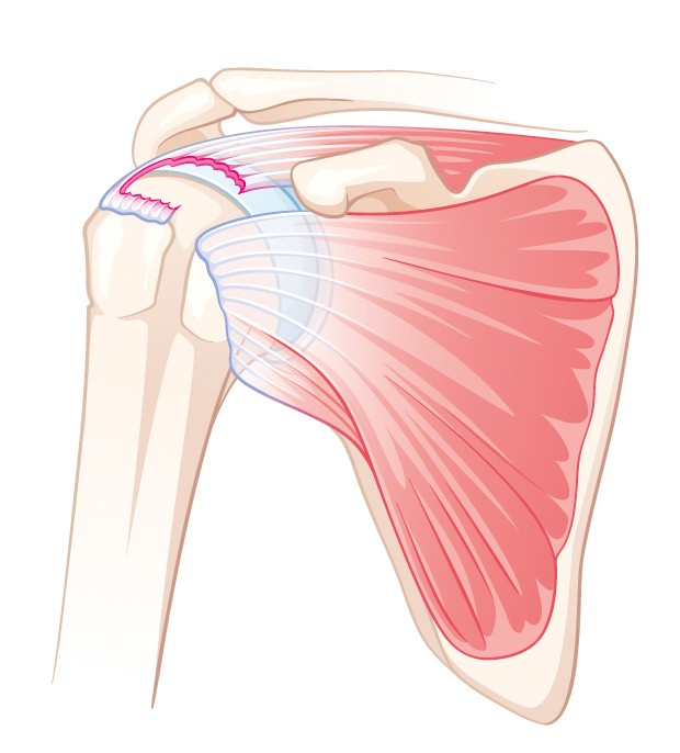 Rotatorenmanschettenruptur | Schulthess Klinik