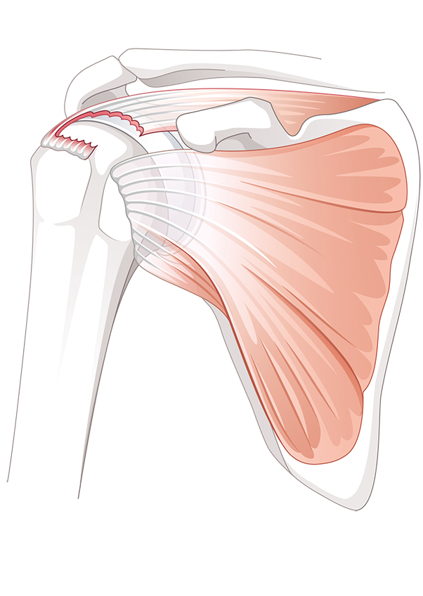 Rotatorenmanschettenruptur | Schulthess Klinik