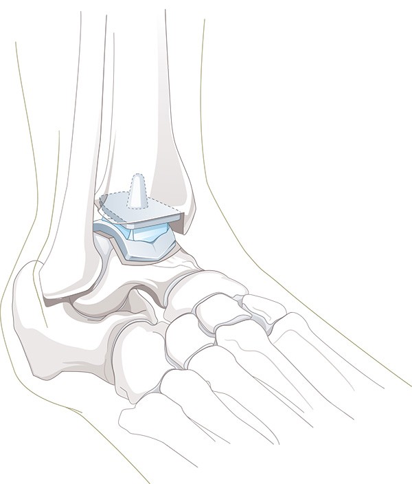 Sprunggelenksarthrose | Schulthess Klinik