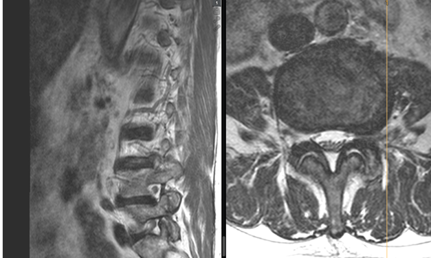 Research award: Successful therapy for painful lateral disc herniation ...