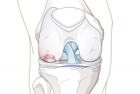 Knieschiene zur Behandlung der Gonarthrose (Arthrose des femoral