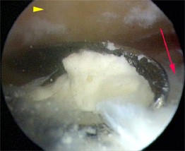 Impingement Syndrom