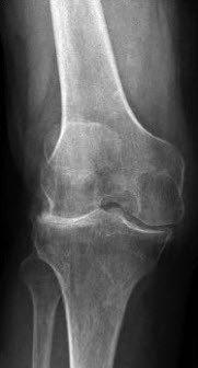 Knieprothese – das künstliche Kniegelenk