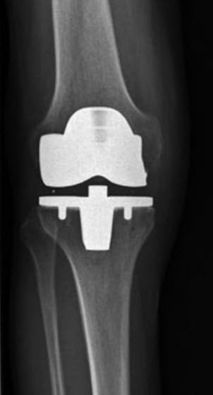 Die Knie-Teilprothese / Schlittenprothese