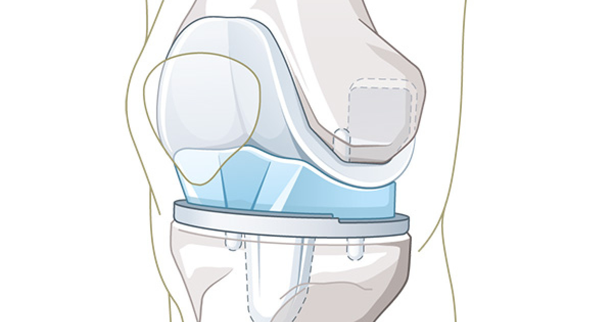 Knieprothese – Das Künstliche Kniegelenk | Schulthess Klinik
