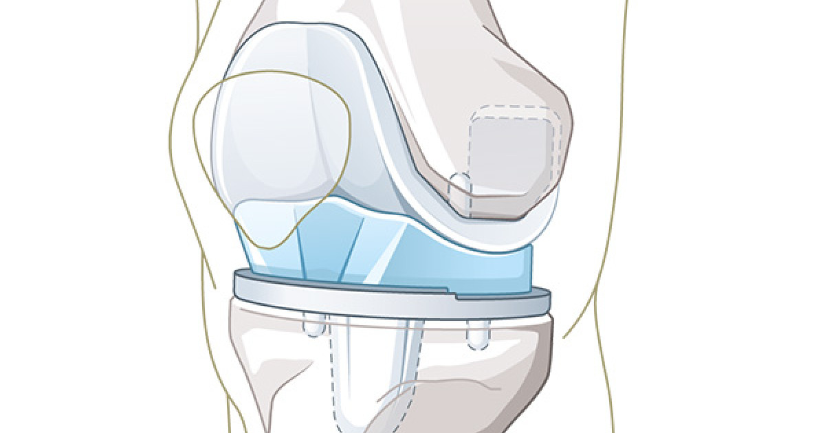 Knieprothese – das künstliche Kniegelenk